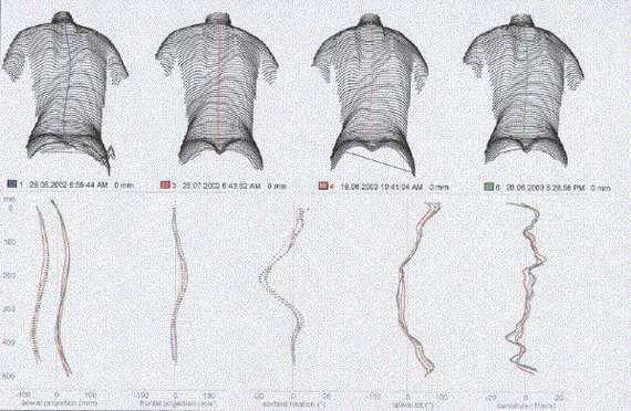 My computer-assessment measurements of my back
